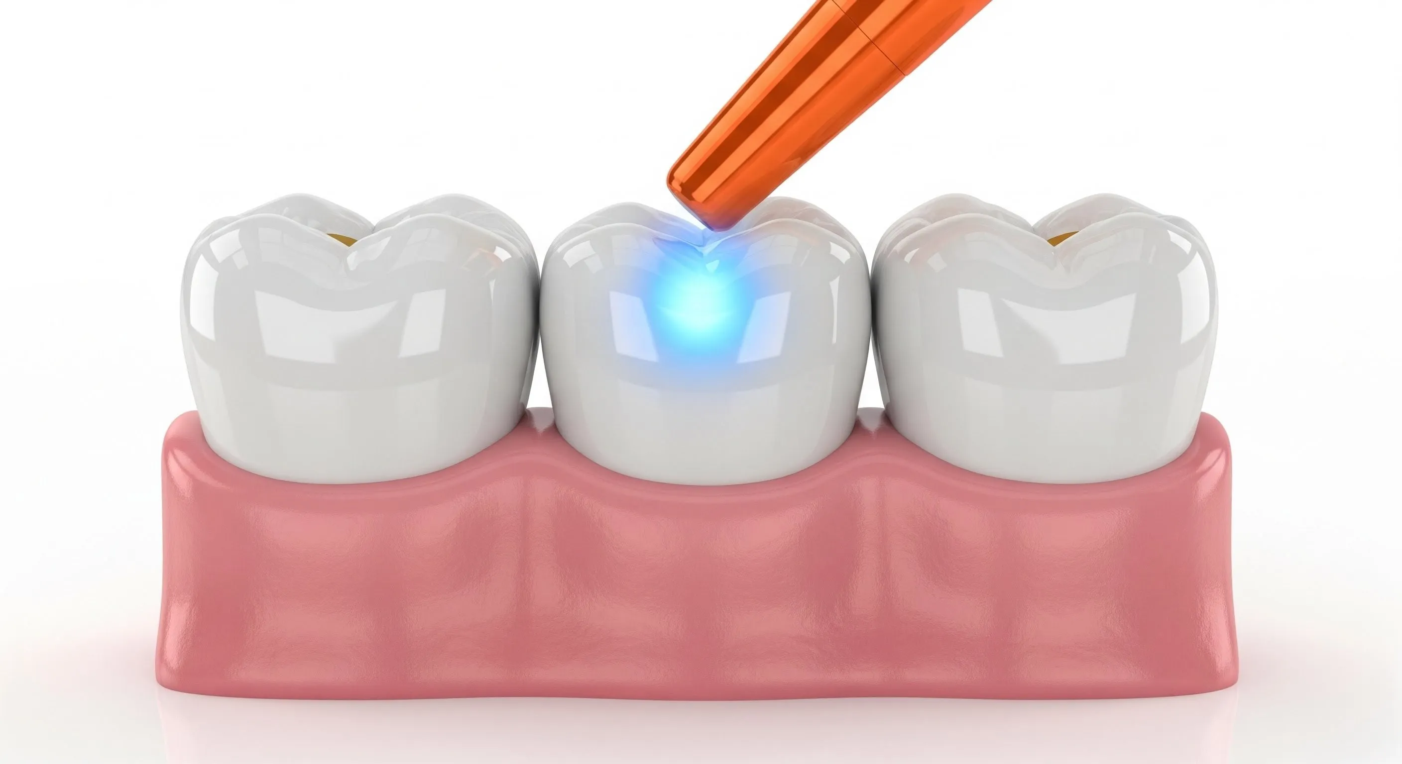 Composite Fillings Cost and Pricing Information in Louisville