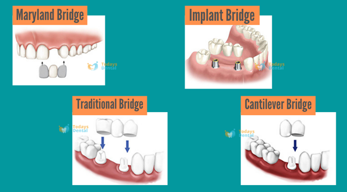   Dentist in Louisville - Dental Bridges