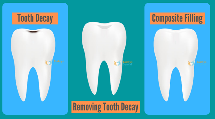 Dentist in Louisville - Composite Filling