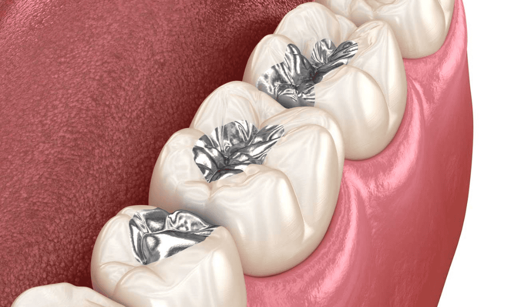 Amalgam Fillings vs Composite Fillings