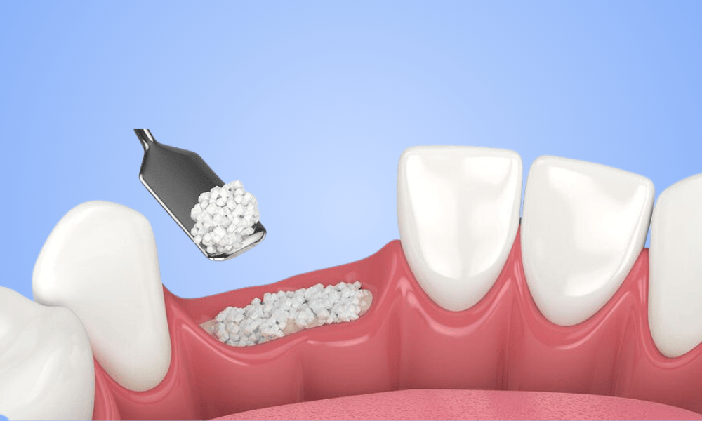 Why Choose Bone Grafting in Louisville?