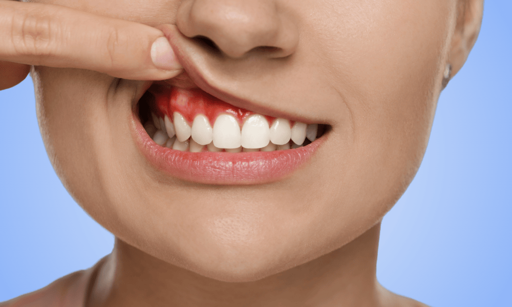 Understanding Gingivitis