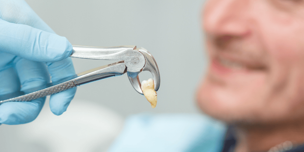 What Is a Dental Extraction