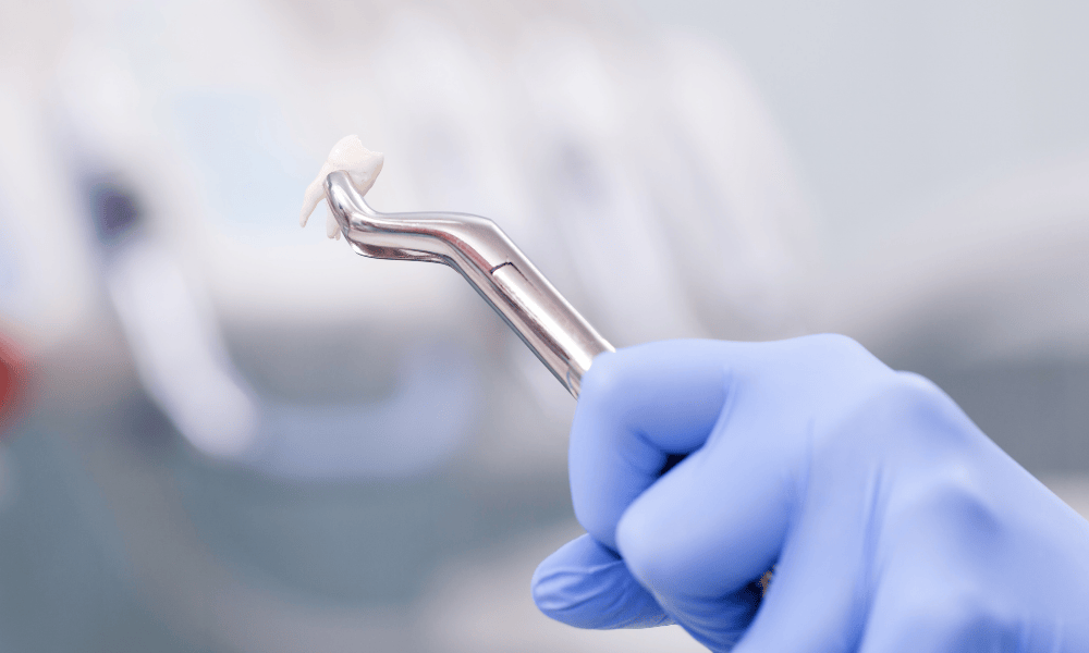 Benefits of Tooth Extractions