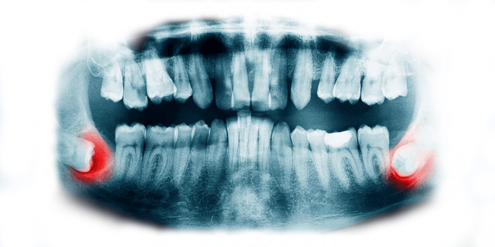 Recognizing Wisdom Tooth Infection Symptoms