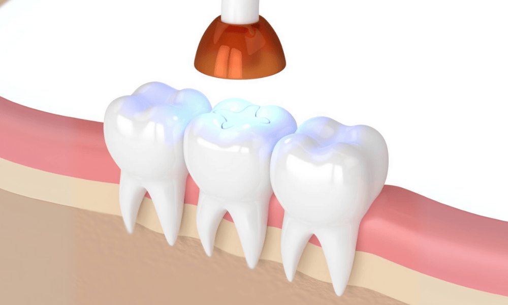 Composite Fillings Cost and Pricing Information in Louisville